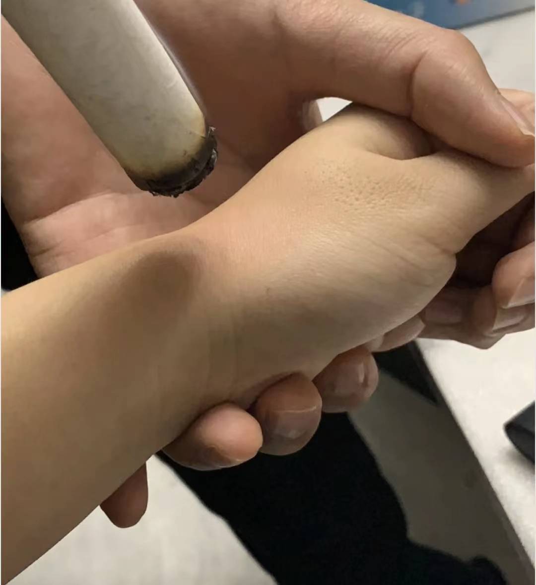打手机游戏会引起腱鞘炎吗-警惕！长时间打手机游戏或致腱鞘炎，